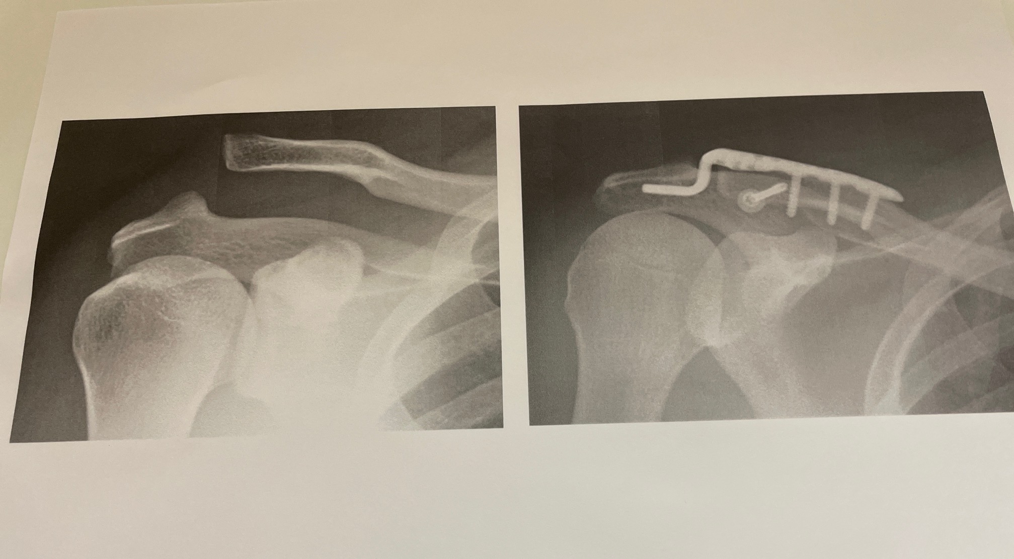 AC関節手術の成功率はどれくらいですか?